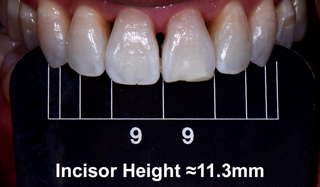 How Bioclear Empowers Dentists To Treat Black Triangles Optident